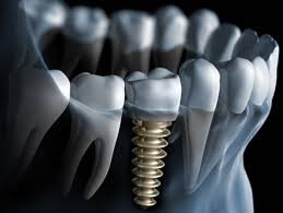 Implant dentaire unitaire
